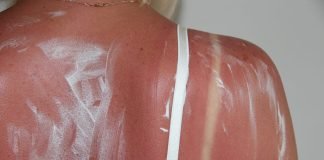 La tanmaxxing spopola sui social, ma è pericolosissima Schiena ustione sole